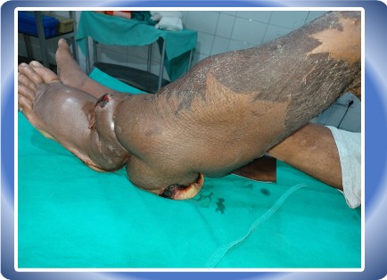 LYMPHOEDEMA LOWER LIMB